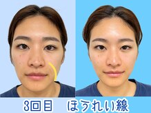 ナチュラルビューティーフェイス 横浜(NBF)/ほうれい線もすっきり/横浜小顔