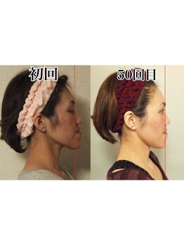 小顔22 ボルティ 本店(Bolty)/【悩み】反対咬合