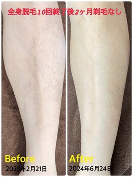 ソレイユ/全身脱毛