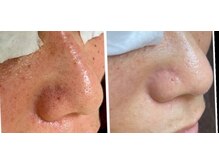 ファミリータイズカンパニーガデス(Family Ties Co. Goddess)/黒ずみ諦めないで【毛穴洗浄】