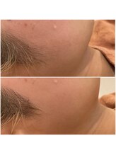 アルカディア(Arcadia)/顔脱毛/ビフォーアフター
