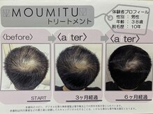 全身脱毛専門店 tenの雰囲気（本格的な育毛促進◎スコープ診断で毛根・頭皮の状態を分析します）