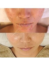 リバージュ(Riverge)/肌改善