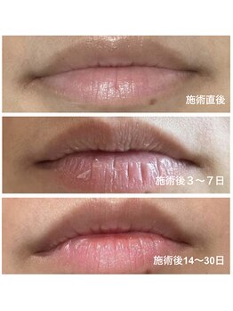 クレッセント(Crescent)の写真/【韓国で大人気】話題のローマピンクが渡韓しなくても出来る!悩みの黒ずみを徹底除去◎驚きの体験を◇