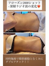 カーム(CALM.)/フローズン×ラジオ波