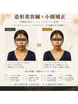 エモシオン トウキョウ(EMOTION TOKYO)/造形美容鍼×小顔矯正