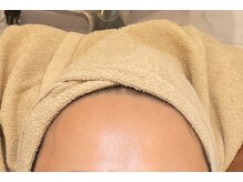 アルカディア(Arcadia)/顔脱毛/ビフォーアフター