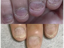 グレースレディ/爪を守りながら矯正