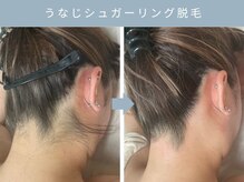 【シュガーリング脱毛】その場でツルツル＆キレイ