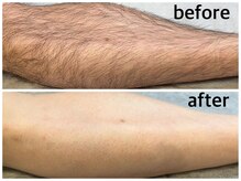 プロッソル こころ(PROSOL)/ひざ下脱毛