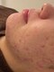 ミソル(misolle.)の写真/【肌質改善】3万人の施術から生まれたニキビケアプログラム！お客様に合った施術やホームケアをご提案◇