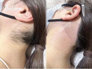 ピミル(PIMIL)/うなじ脱毛