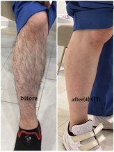 モット いこらもーる泉佐野店(mot)/脚フル脱毛★