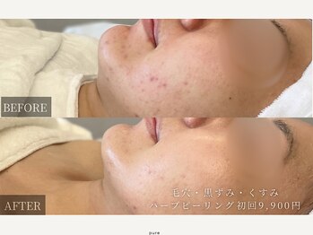 ピュア(pure)/ピーリング1回