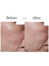 プレイス 天王寺店(PLACE)/ハーブピーリング