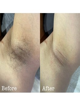 ア レーズ(a laise)/ワキのダブル脱毛☆