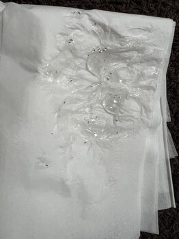 フェリッセ(FELISSE)/ヒゲ脱毛1回目 施術直後