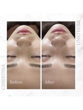 シャルムパリス(charme paris)/うる艶肌へ◎１回の施術変化