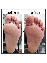 ザ カリビア(The CAREBEA)/角質ケア