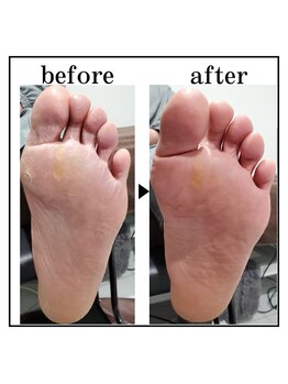 ザ カリビア(The CAREBEA)/角質ケア