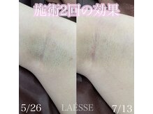 ラエッセ(LAESSE)/黒いポツポツもサヨナラ♪