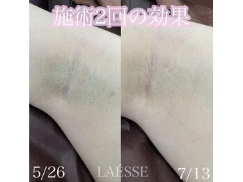 ラエッセ(LAESSE)/黒いポツポツもサヨナラ♪