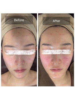 ラビ(RABBI)/20代女性小顔矯正