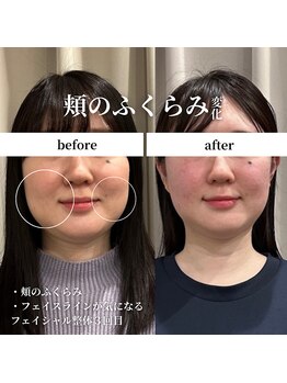 フェアリーフェイス 南森町店(Fairy Face)/【南森町/小顔矯正】頬ふくらみ