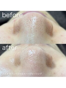 ルルラ リコ(lulula rico)/症例写真/ハイドラ毛穴洗浄