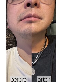 アネラ バイ アンレーブ(ANELA by Un.Reve)/ヒゲ脱毛【施術8回】