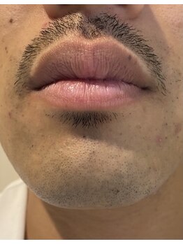 アトリウムオム 博多(ATRIUM HOMME)/ヒゲ脱毛実施前