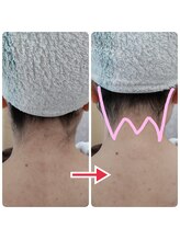 エステシェービングサロン フルール(Fleur)/うなじのビフォーアフター