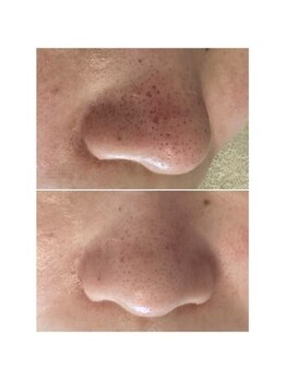 マヴィ 香里園店(MavY.)/毛穴洗浄Tゾーンお鼻コース