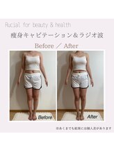 ルシアル(Rucial)/痩身◇ビフォー／アフター