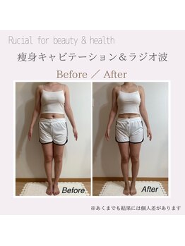 ルシアル(Rucial)/痩身◇ビフォー／アフター