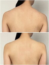 モア(moa)/背中美人