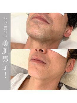 シアー(SHEER)/■メンズひげ脱毛