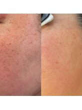 プルメリア(Plumeria)/シミケア