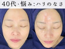 ジョンミー(JONMEE)/ピーリングで、ハリツヤUP！