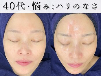 ジョンミー(JONMEE)/ピーリングで、ハリツヤUP!