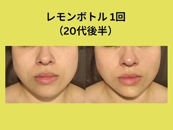 アユアラングレース/レモンボトル1回