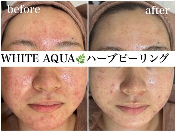 アワピール 天王寺店(AWA PEELL)/ハーブピーリング/ニキビケア