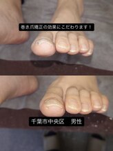 巻き爪じゅん 船橋店/巻き爪の強い痛みに悩む方へ