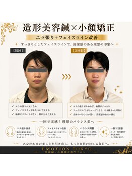 エモシオン トウキョウ(EMOTION TOKYO)/造形美容鍼×小顔矯正