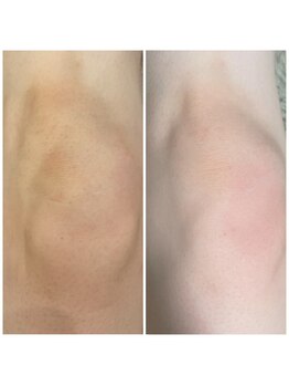 アルカディア(Arcadia)/ひざ脱毛/ビフォーアフター