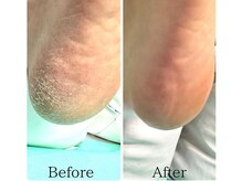 巻き爪補正店 徳重店の雰囲気(トータル角質ケアでツルツル足裏)