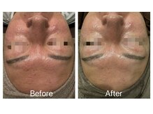 アトリエール(Ateliere)/赤ら顔に◎ハイドラフェイシャル