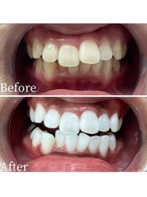 ホワイト 福岡天神店(WHITE)/ホワイトニングビフォーアフター