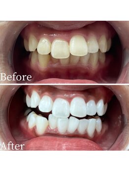 ホワイト 福岡天神店(WHITE)/ホワイトニングビフォーアフター