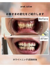 アレッド 大阪店(ared.)/ホワイトニング